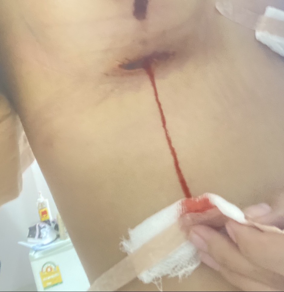 Nach Angaben der Betroffenen trat aus der Operationswunde unter der linken Brust wiederholt Blut aus. Bild: TMN.TV